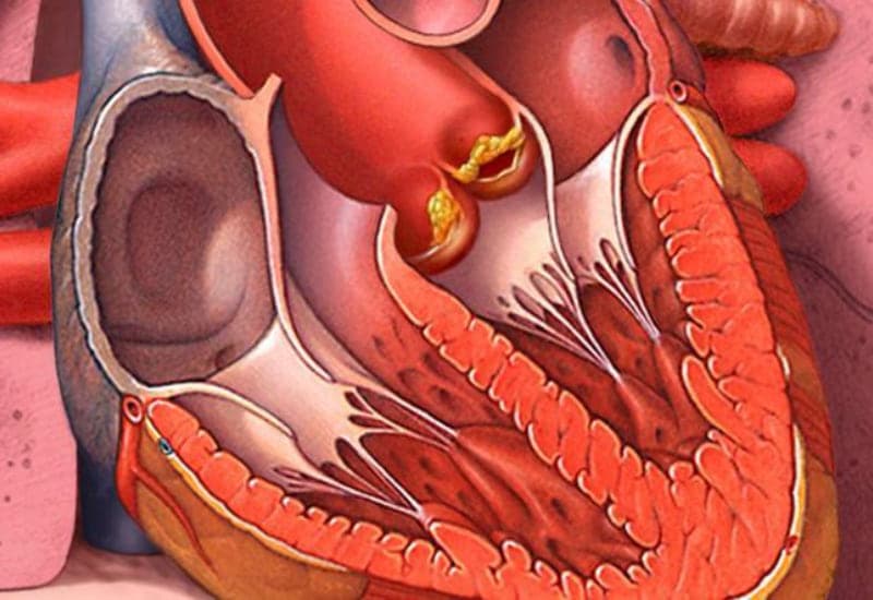 phác đồ điều trị suy tim ở trẻ em