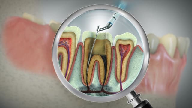 Viêm tủy răng không hồi phục là gì?