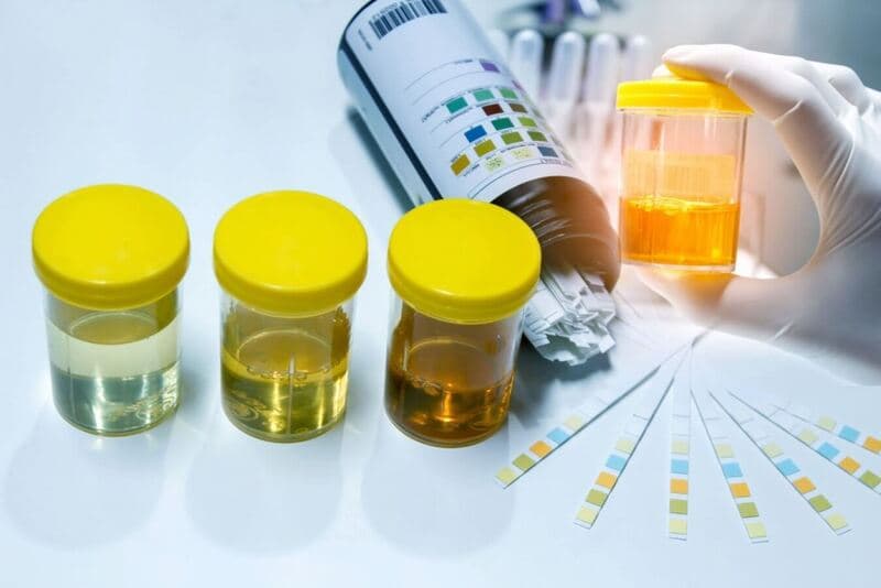xét nghiệm nước tiểu có ra bệnh lậu không