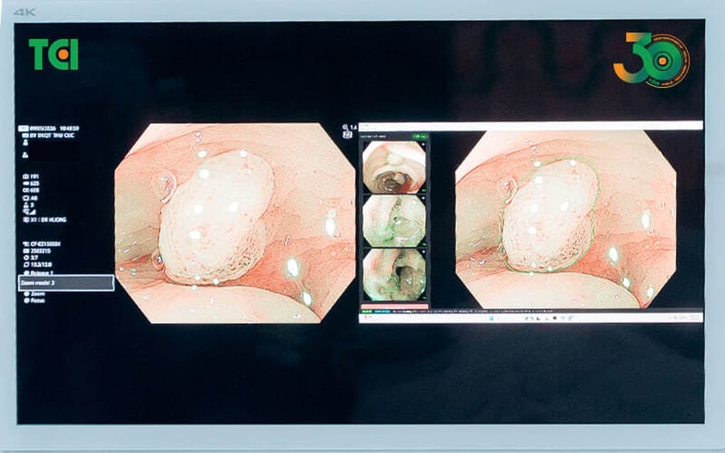 Các polyp đại tràng kích thước lớn có nguy cơ tiến triển thành ung thư (Ảnh Thu Cúc TCI).