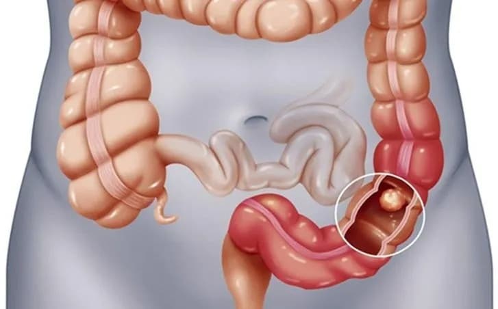 Hiện chỉ có 5–10% trường hợp ung thư đại trực tràng liên quan đến các hội chứng di truyền