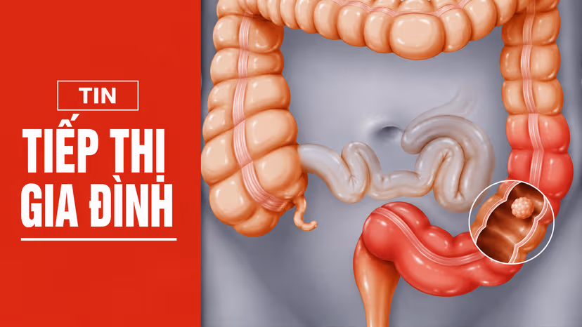 Người thân mắc ung thư tiêu hóa: Gia đình cần làm gì?