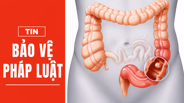 Nội soi định kỳ – “Vũ khí số 1” trong cuộc chiến chống ung thư tiêu hóa
