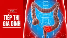 Từ polyp đến ung thư: Hành trình 10 năm có thể ngăn chặn