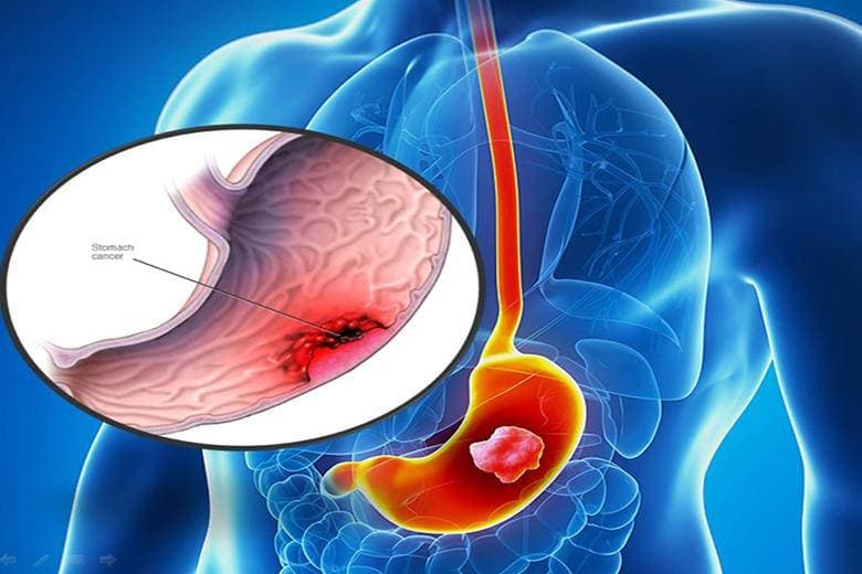 Ung thư dạ dày thuộc nhóm các bệnh ác tính phổ biến tại Việt Nam