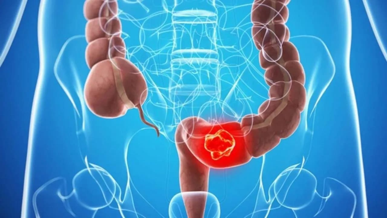 Ung thư đại tràng có thể được khởi phát từ các polyp tuyến.