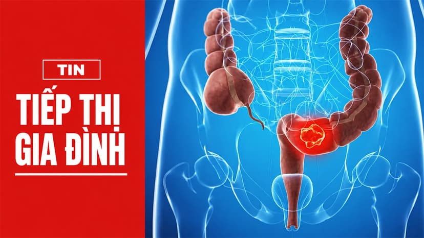 Từ polyp đến ung thư: Hành trình 10 năm có thể ngăn chặn