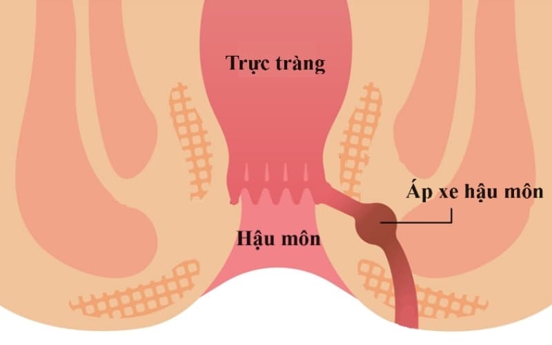 áp xe hậu môn và rò hậu môn
