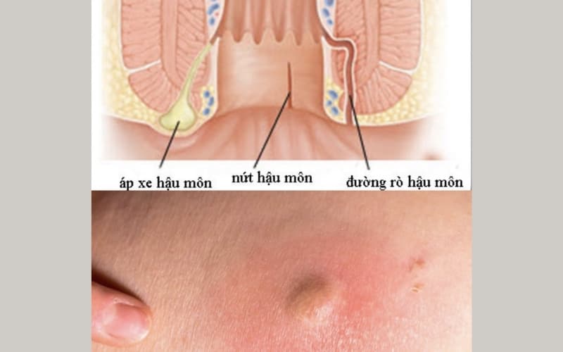 cách trị áp xe hậu môn tại nhà