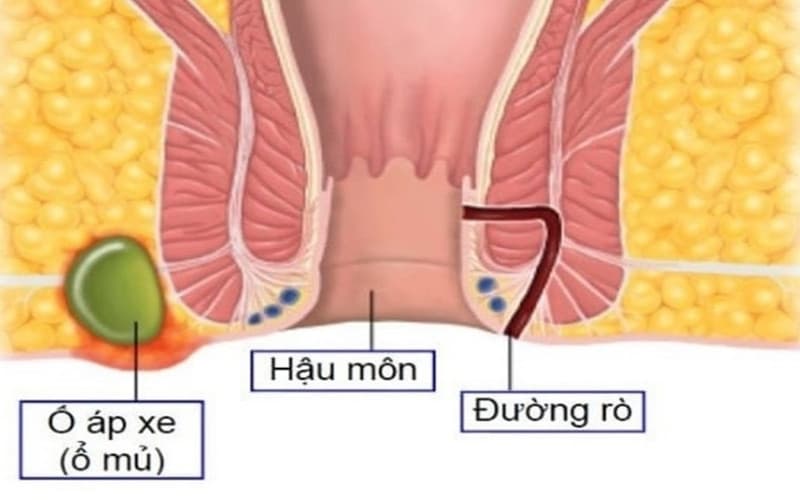 áp xe hậu môn và rò hậu môn