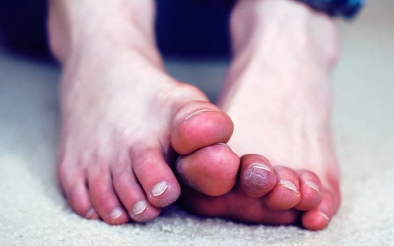 bàn chân lạnh dấu hiệu bệnh gì