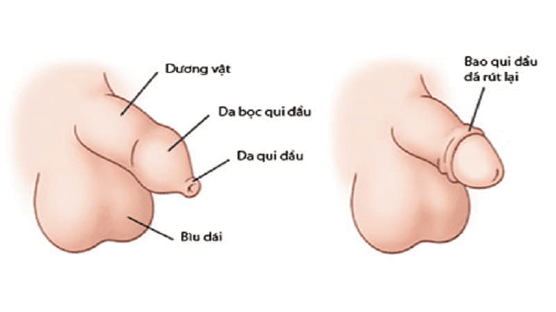 cắt bao quy đầu