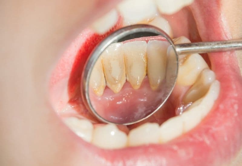 bầu lấy cao răng được không