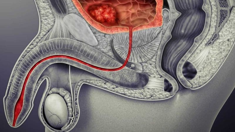 giãn tĩnh mạch thừng tinh có nguy hiểm không