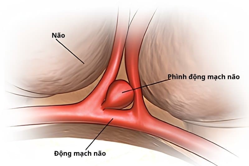 Phình động mạch não có nguy hiểm không?
