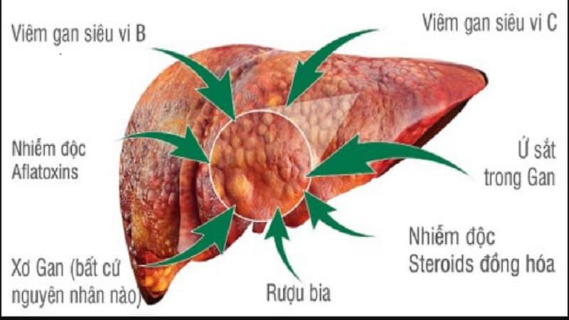 Mắt vàng là dấu hiệu bệnh gì?