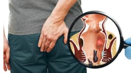 Bị áp xe hậu môn nên kiêng ăn gì, gợi ý chế độ ăn phù hợp