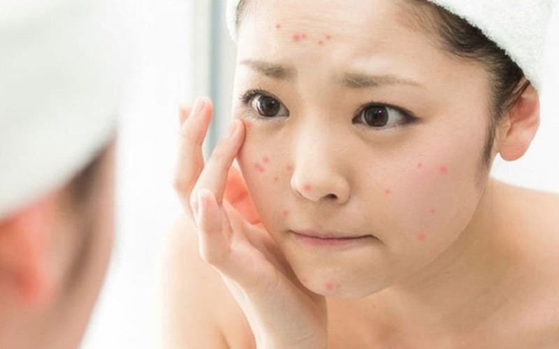 vị trí mụn trên mặt và dấu hiệu bệnh tật