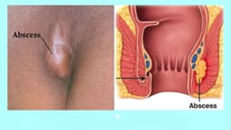 Cách trị áp xe hậu môn tại nhà: Khi nào có thể tự chăm sóc và khi nào cần đi khám?