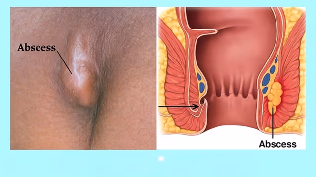 Cách trị áp xe hậu môn tại nhà: Khi nào có thể tự chăm sóc và khi nào cần đi khám?