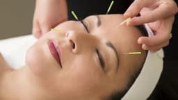 Châm cứu liệt mặt có hiệu quả không và những điều cần lưu ý