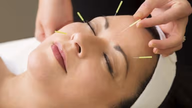 Châm cứu liệt mặt có hiệu quả không và những điều cần lưu ý