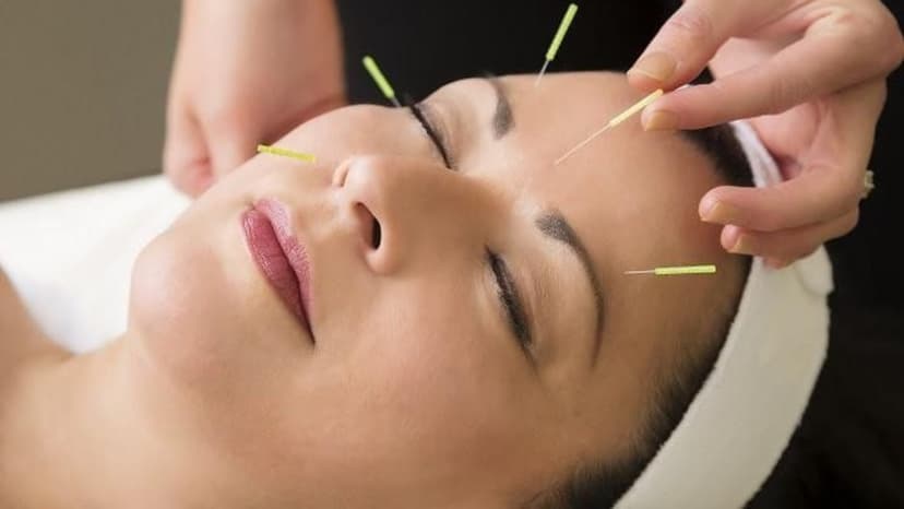 Châm cứu liệt mặt có hiệu quả không và những điều cần lưu ý