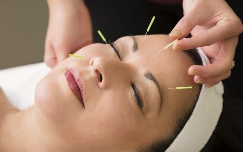 châm cứu liệt mặt