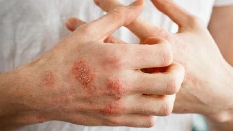 dấu hiệu bệnh chàm da