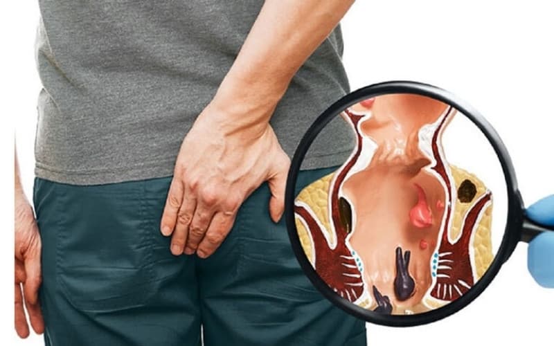 bị áp xe hậu môn nên kiêng ăn gì