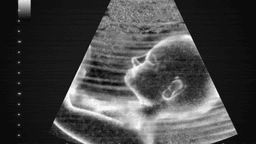 Chiều dài xương mũi thai nhi 16 tuần