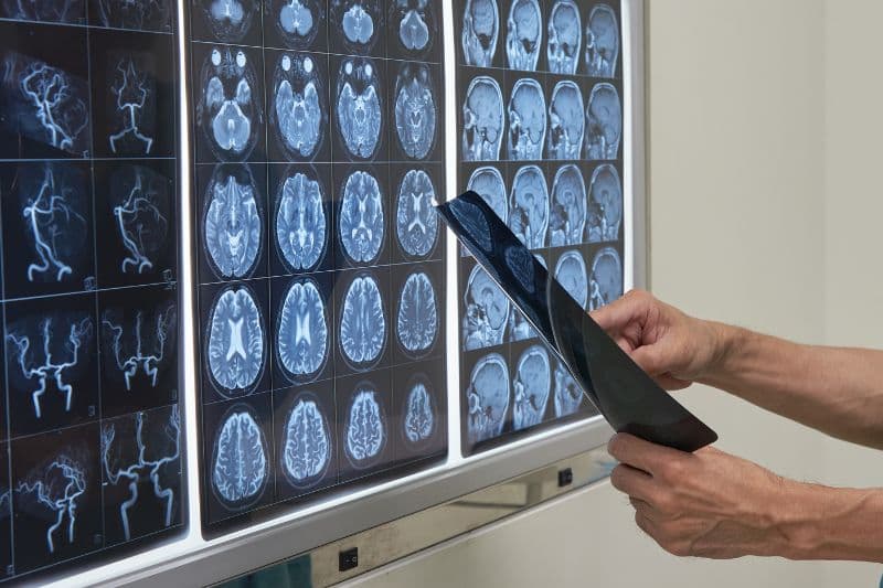 chụp MRI có biết đột quỵ không