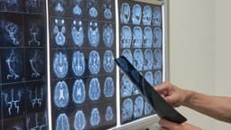 Chụp MRI có phát hiện đột quỵ không?