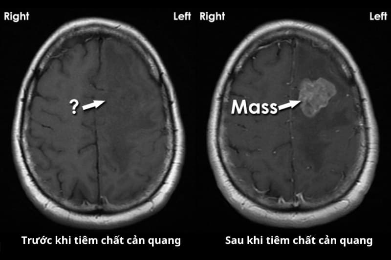 chụp mri não có cần tiêm thuốc cản quang không