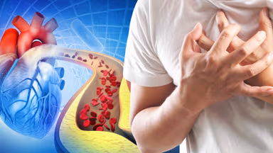 Ai cần tầm soát đột quỵ sớm? Giải đáp