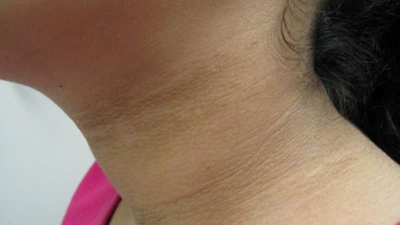 da sạm đen dấu hiệu bệnh gì