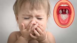 Dấu hiệu bệnh bạch hầu ở trẻ em