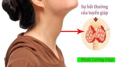 Dấu hiệu bệnh cường giáp ở nữ