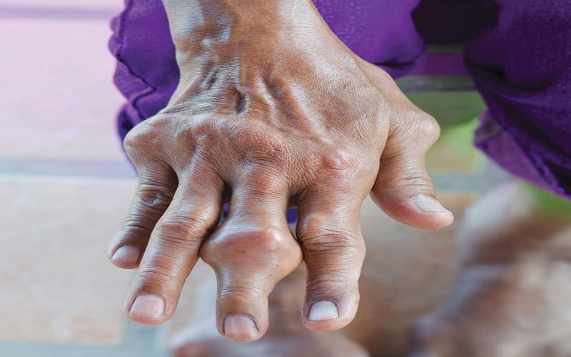 dấu hiệu bệnh gout ở nam