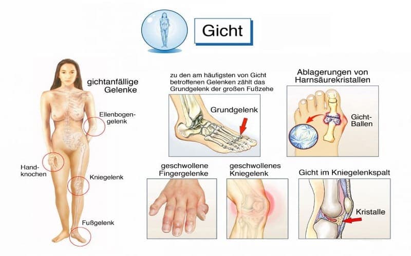 dấu hiệu bệnh gout ở nam