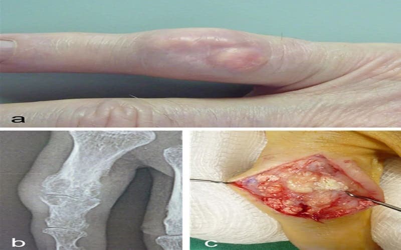 Dấu hiệu bệnh gout ở ngón tay
