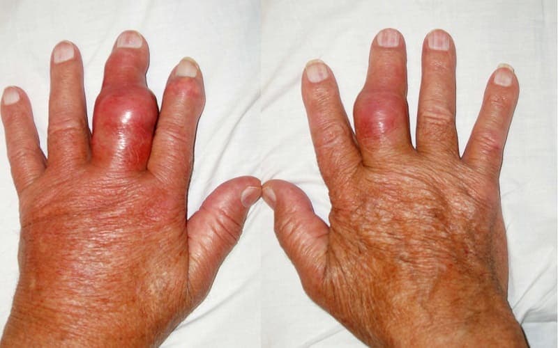 Dấu hiệu bệnh gout ở ngón tay