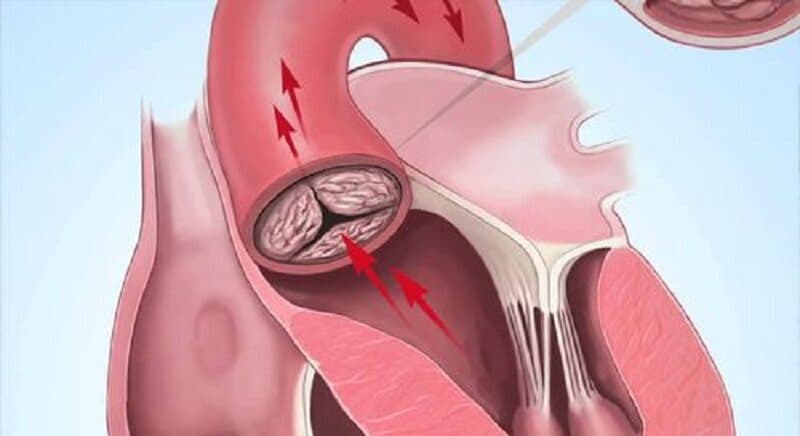 dấu hiệu của bệnh hở van tim 2 lá
