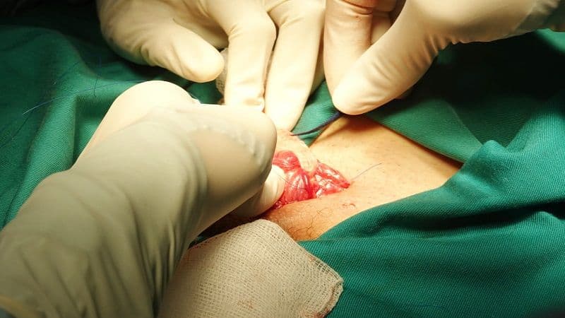 giãn tĩnh mạch thừng tinh có con được không
