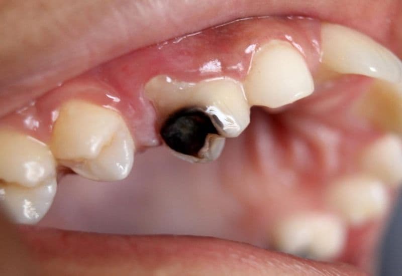 điều trị răng sâu vào tủy có đau không
