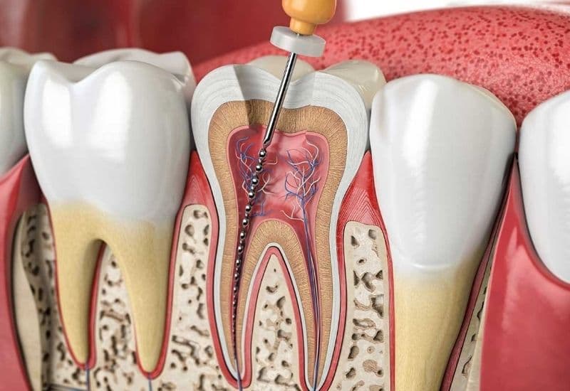 điều trị răng sâu vào tủy có đau không