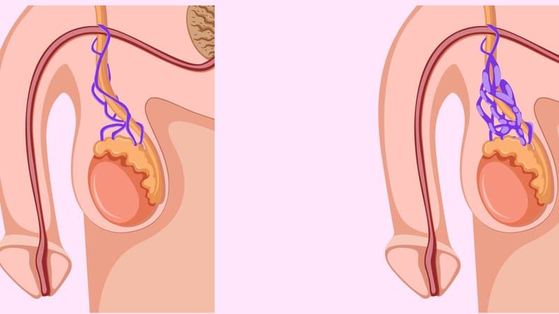 giãn tĩnh mạch thừng tinh 2 bên