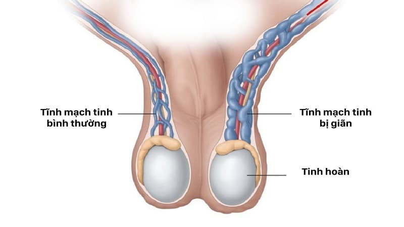 giãn tĩnh mạch thừng tinh có con được không