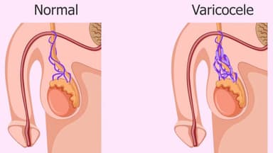 Giãn tĩnh mạch thừng tinh uống thuốc có khỏi không? Các loại thuốc điều trị