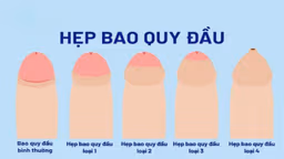 Hẹp bao quy đầu là gì? Dấu hiệu nhận biết ở người lớn và trẻ em
